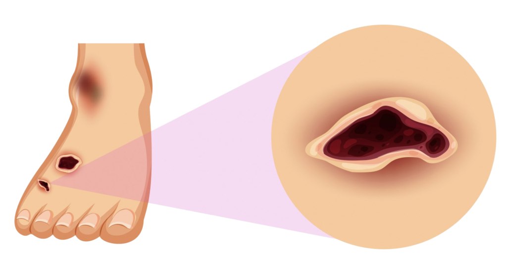 an illustration of an diabetic foot.